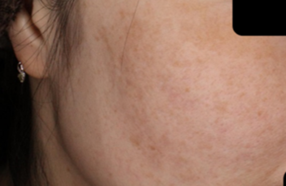 co2-surgical-fractional-laser-groove-marionetteLine