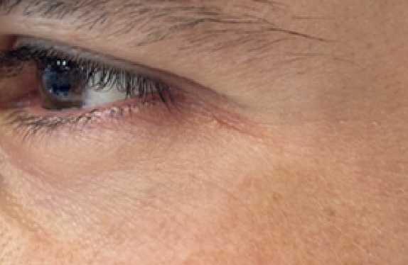 co2-surgical-fractional-laser-milium