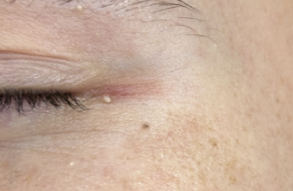 co2-surgical-fractional-laser-milium