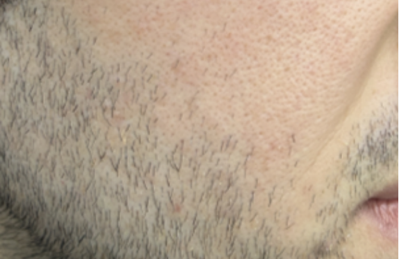 co2-surgical-fractional-laser-moleRemoval