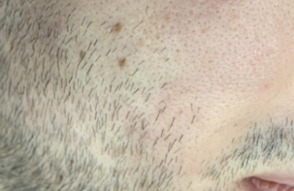 co2-surgical-fractional-laser-moleRemoval