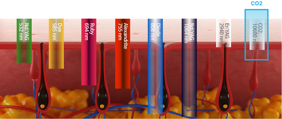 ndYag-dye-ruby-alexandrite-diode-erYag-CO2-Surgical-fractional