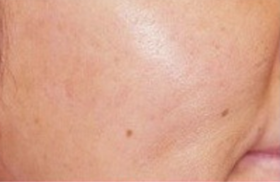 co2-surgical-fractional-laser-acneScar