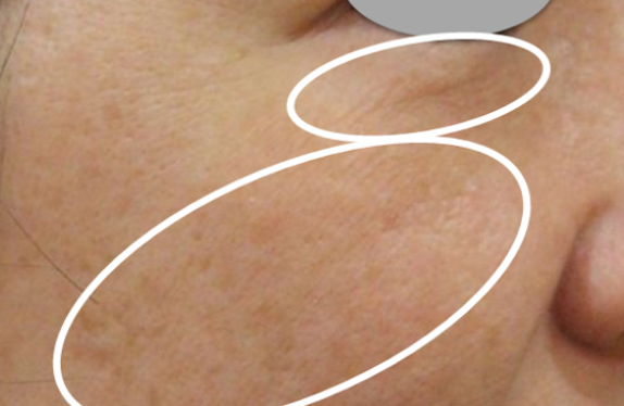 co2-surgical-fractional-laser-skinDepression