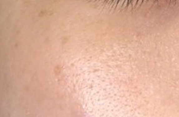 co2-surgical-fractional-laser-poreTightening