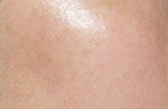 co2-surgical-fractional-laser-skinResurfacing