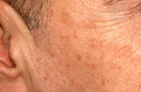 co2-surgical-laser-ageSpot