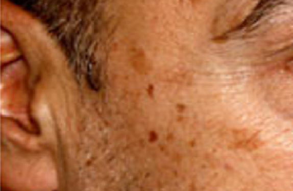 co2-surgical-laser-ageSpot