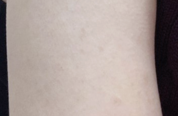 co2-surgical-laser-cherryHemangioma