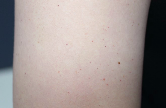 co2-surgical-laser-cherryHemangioma