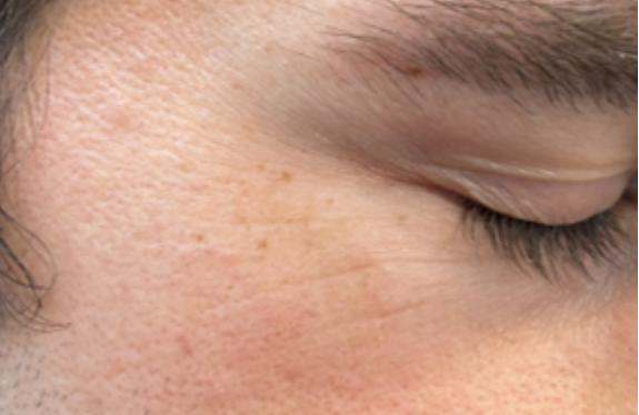 co2-surgical-fractional-laser-mlilun