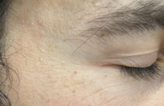 co2-surgical-fractional-laser-mlilun