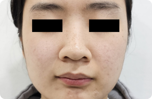 Q-Switched & Long-Pulsed Nd:YAG Laser_Gold PTT Acne