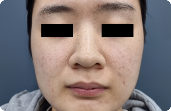 Q-Switched & Long-Pulsed Nd:YAG Laser_Gold PTT Acne