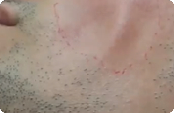 Q-Switched & Long-Pulsed Nd:YAG Laser_Hair Removal