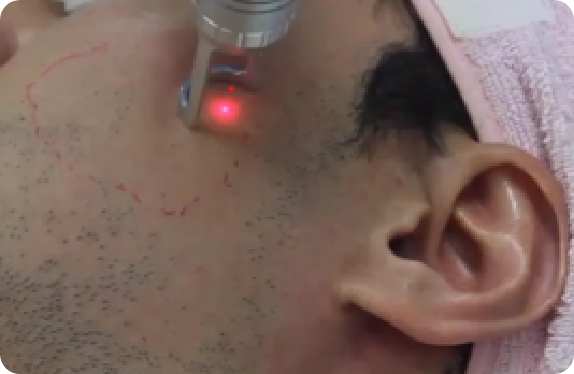 Q-Switched & Long-Pulsed Nd:YAG Laser_Hair Removal