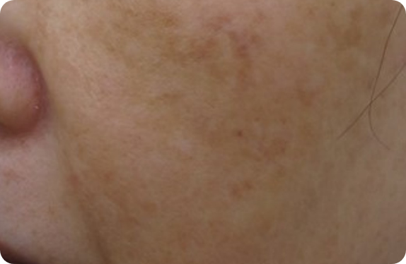 Q-Switched & Long-Pulsed Nd:YAG Laser_Melasma & Flush