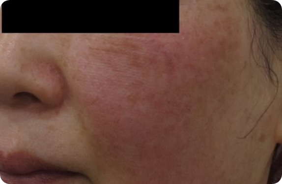Q-Switched & Long-Pulsed Nd:YAG Laser_Melasma & Flush