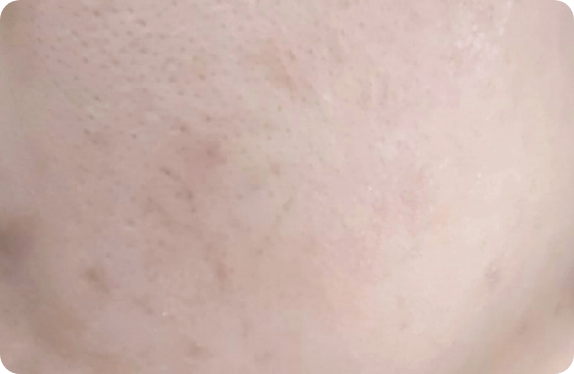 Q-Switched & Long-Pulsed Nd:YAG Laser_Telangiectasia