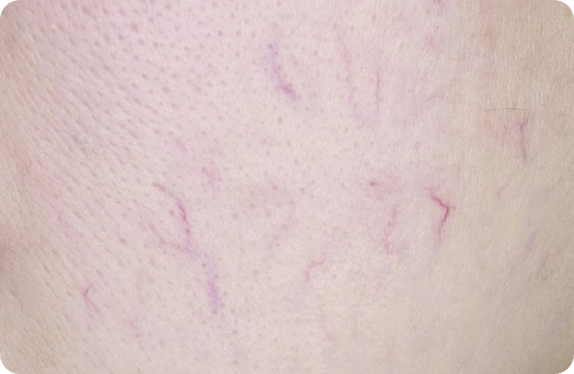 Q-Switched & Long-Pulsed Nd:YAG Laser_Telangiectasia