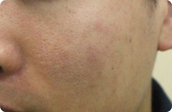 Q-Switched & Long-Pulsed Nd:YAG Laser_Pore & Scar