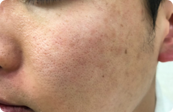 Q-Switched & Long-Pulsed Nd:YAG Laser_Pore & Scar