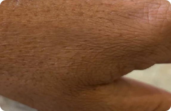 Q-Switched & Long-Pulsed Nd:YAG Laser_Tatto Removal