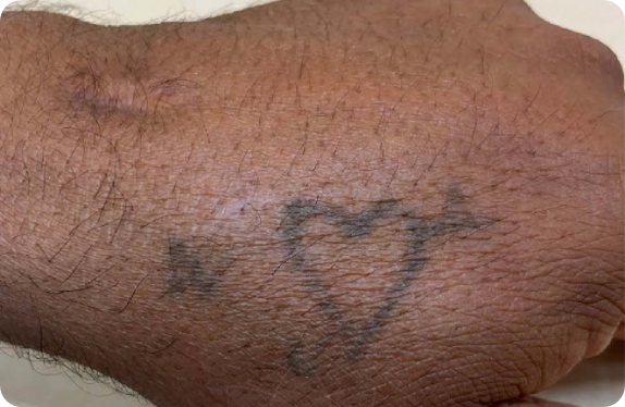 Q-Switched & Long-Pulsed Nd:YAG Laser_Tatto Removal