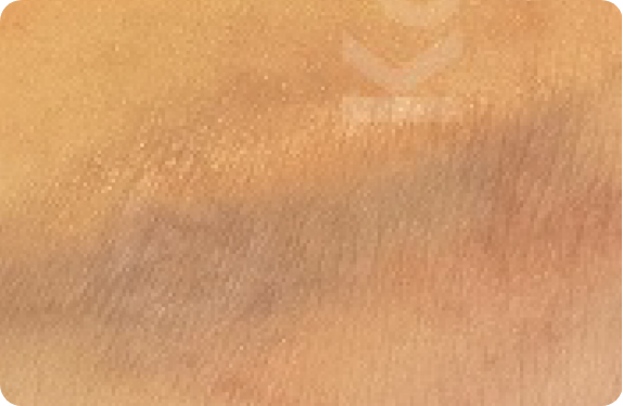 Q-Switched & Long-Pulsed Nd:YAG Laser_Tatto Removal