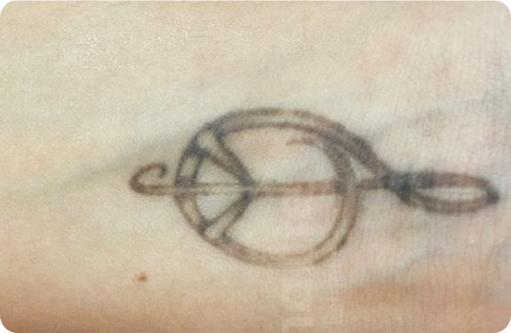 Q-Switched & Long-Pulsed Nd:YAG Laser_Tatto Removal