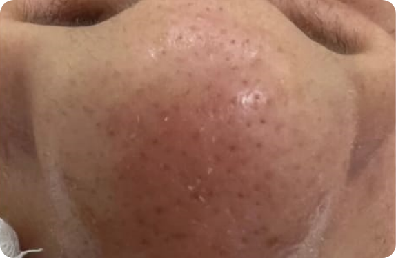 Q-Switched Nd:YAG Laser_Black Head Clearance