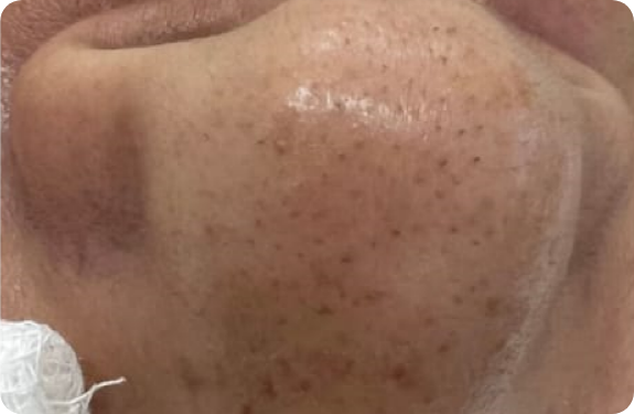 Q-Switched Nd:YAG Laser_Black Head Clearance