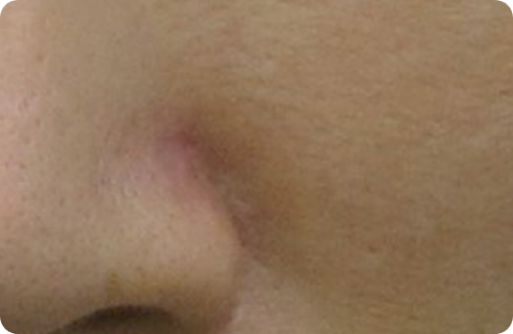 Q-Switched  Nd:YAG Laser_Freckle