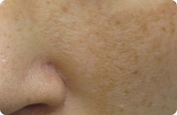 Q-Switched  Nd:YAG Laser_Freckle