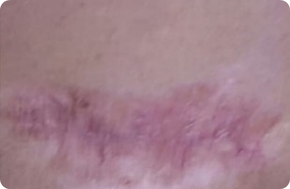 Q-Switched  Nd:YAG Laser_Keloid Erythema Removal