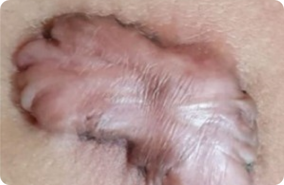 Q-Switched  Nd:YAG Laser_Keloid Erythema Removal