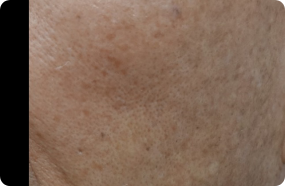 Q-Switched  Nd:YAG Laser_Melasma & PIH