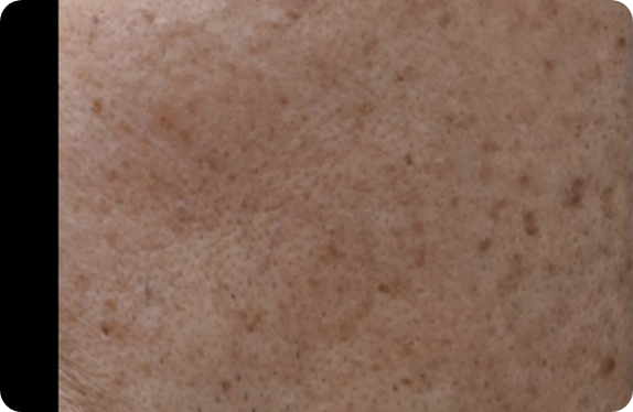 Q-Switched  Nd:YAG Laser_Melasma & PIH