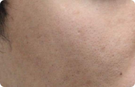 Q-Switched  Nd:YAG Laser_Pore & Scar