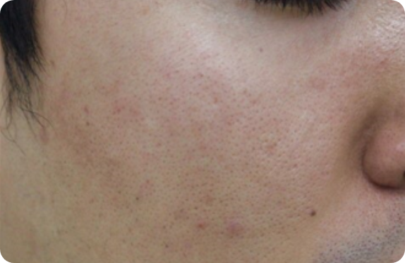 Q-Switched  Nd:YAG Laser_Pore & Scar