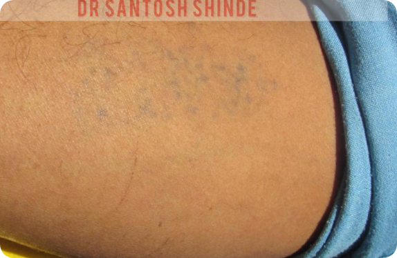 Q-Switched Nd:YAG Laser_Tatto Removal