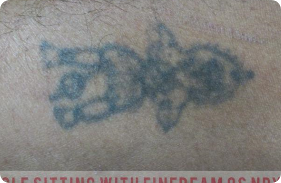 Q-Switched Nd:YAG Laser_Tatto Removal