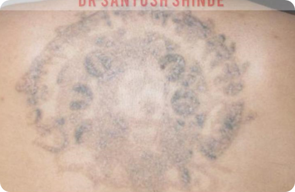 Q-Switched Nd:YAG Laser_Tatto Removal