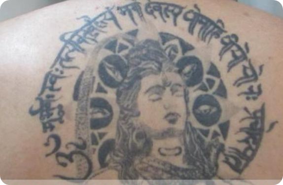 Q-Switched Nd:YAG Laser_Tatto Removal