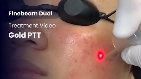 Q-Switched & Long-Pulsed Nd:YAG Laser_Gold PTT