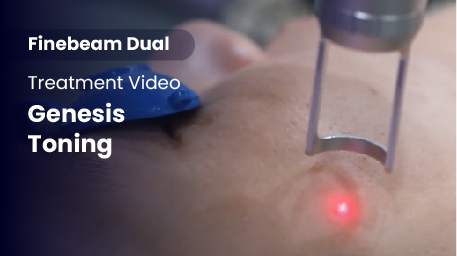 Q-Switched & Long-Pulsed Nd:YAG Laser_Genesis Toning