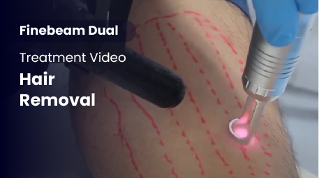 Q-Switched & Long-Pulsed Nd:YAG Laser_Hair Removal