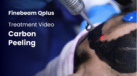 Q-Switched Nd:YAG Laser_Carbon Peeling