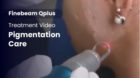 Q-Switched Nd:YAG Laser_Pigmentation Care