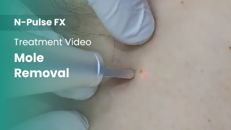 co2-surgical-fractional-laser-mole-removal